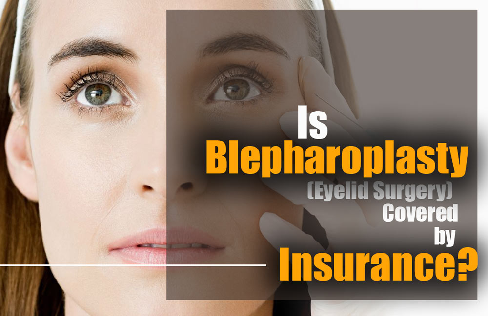 is blepharoplasty covered by insurance terbaru