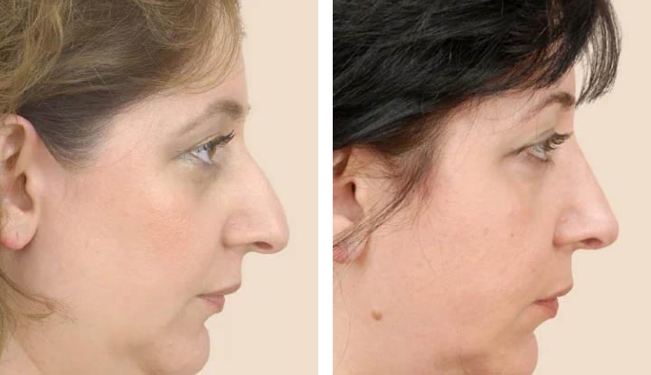 nose job surgical non filler after rhinoplasty surgery jobs without profile reshaping plastic reach sc left