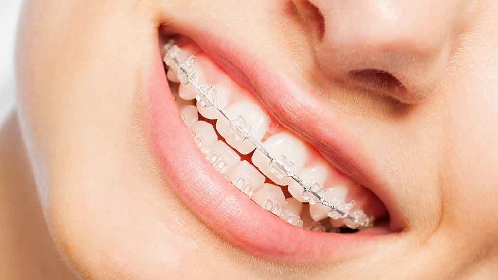 can insurance cover braces