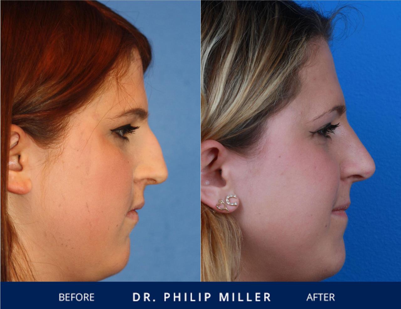 does insurance cover nose job