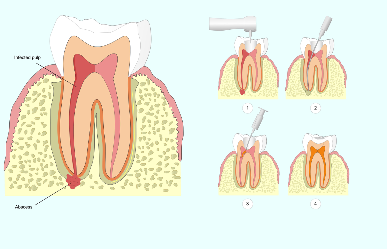 does insurance cover root canal