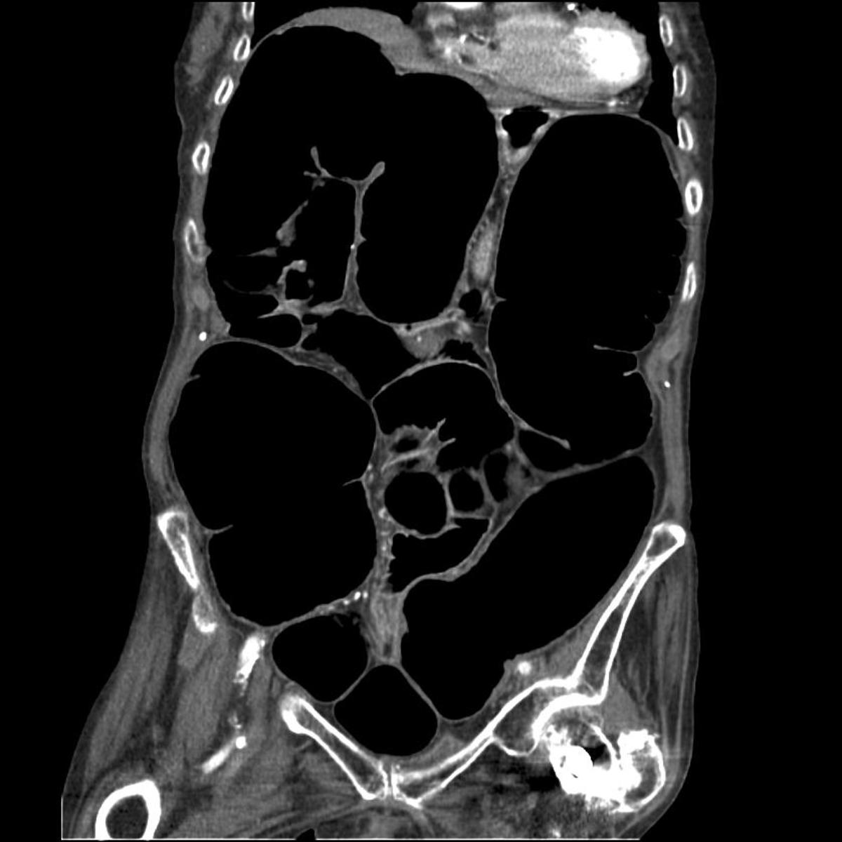 ct ogilvie obstruction scan contrast pelvis syndrome pseudo colonic without abdomen acute abdominal colon bowel dilated coronal showing constipation severe