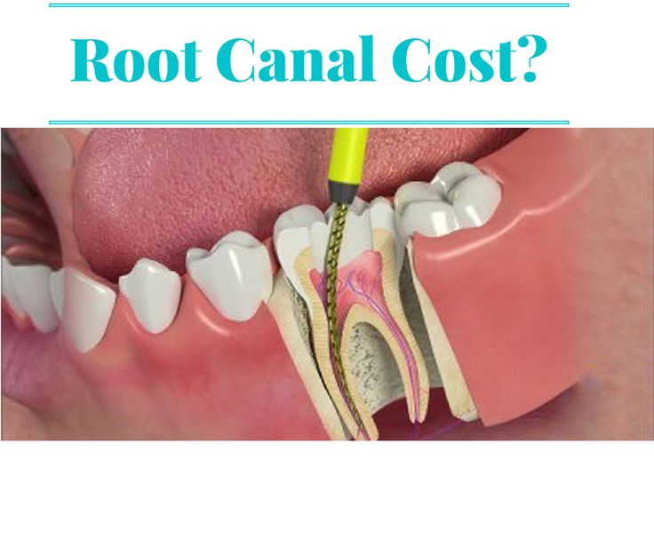 cost of root canal and crown with insurance terbaru