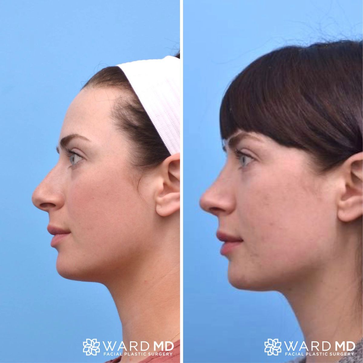 rhinoplasty andrews covered seattle job