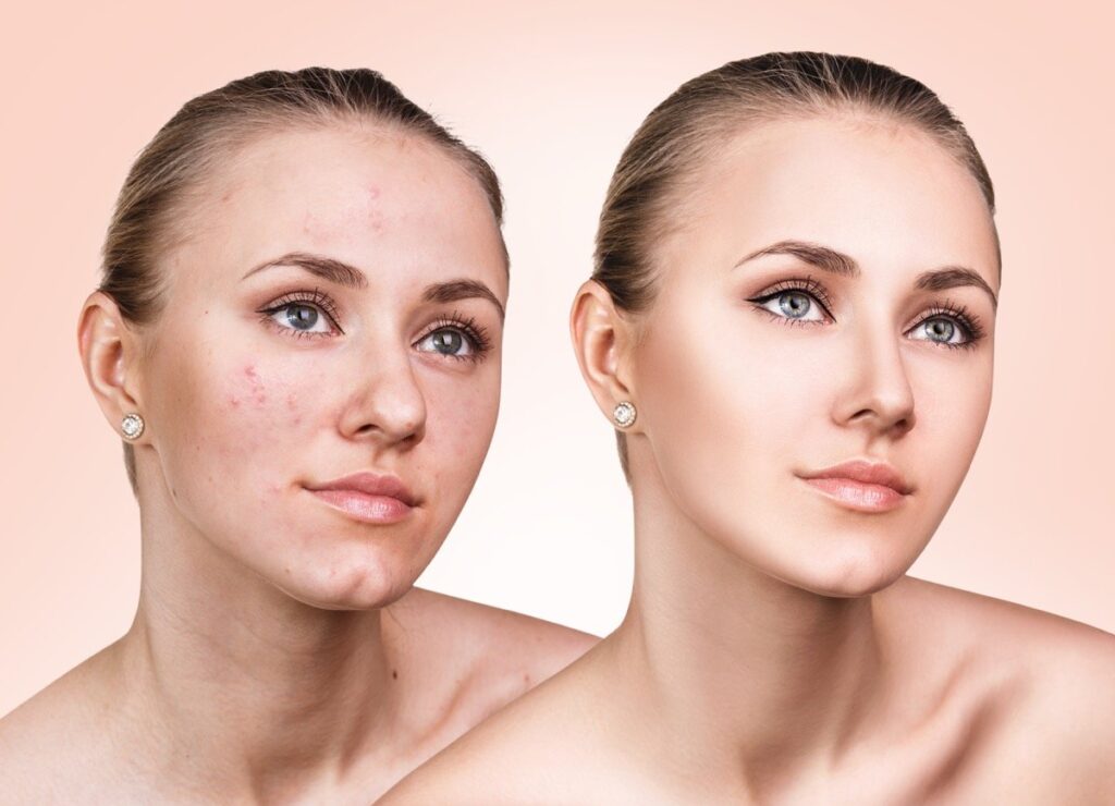 is skin removal surgery covered by insurance terbaru