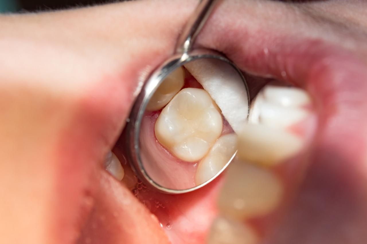how much is dental filling without insurance terbaru