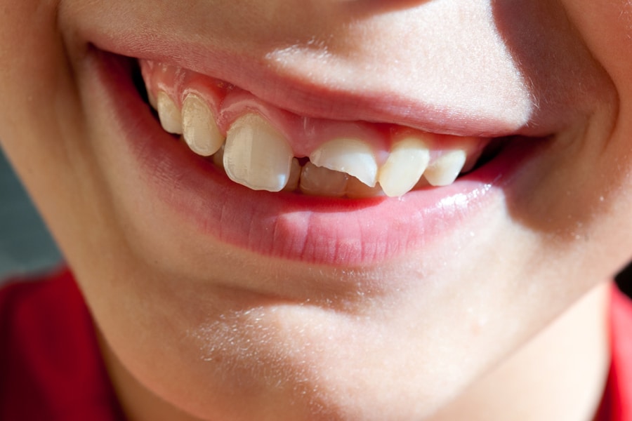 how much to fix a broken tooth without insurance