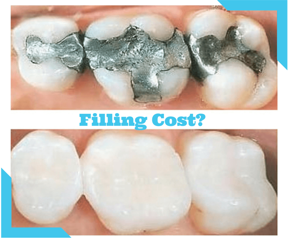 fillings dental filling cost procedure