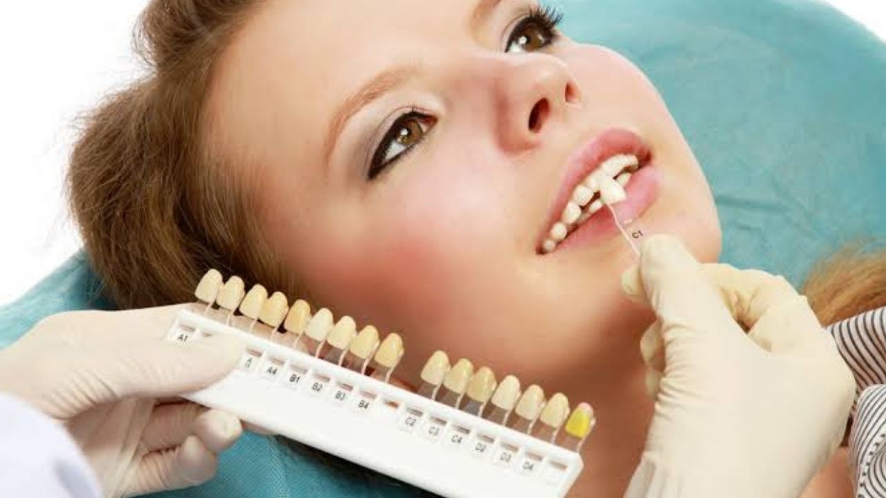 is teeth whitening covered by insurance terbaru
