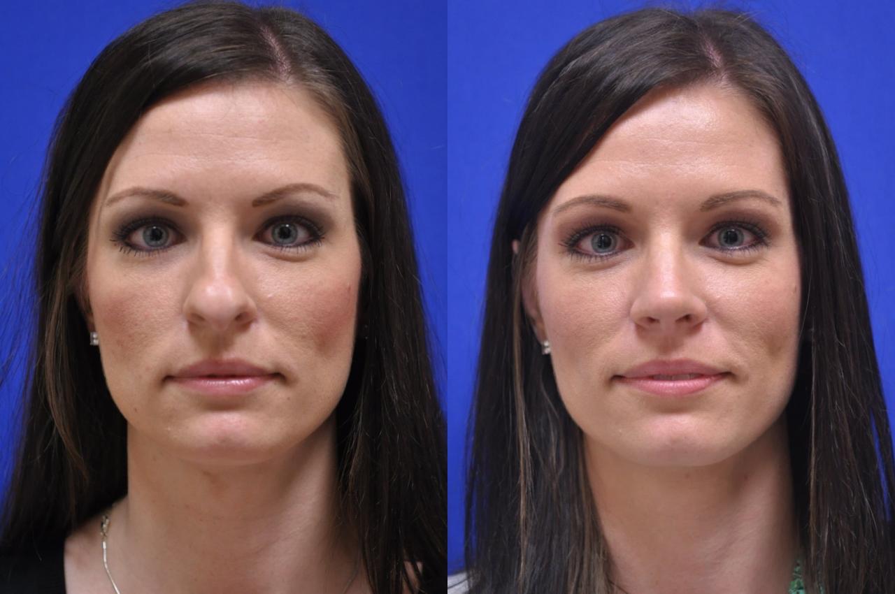 can insurance cover rhinoplasty