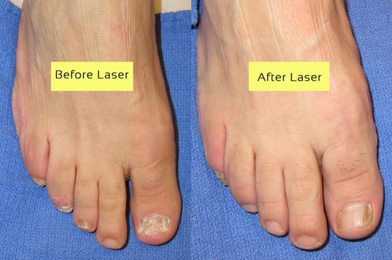 does insurance cover laser treatment for toenail fungus
