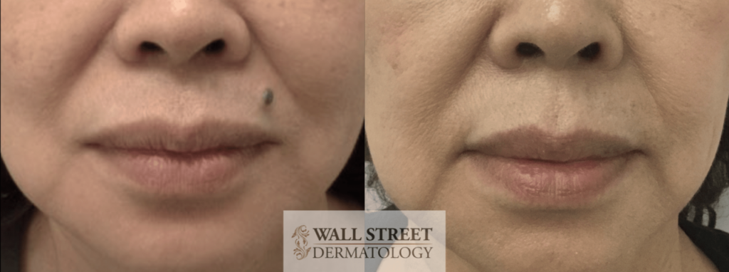 does insurance cover mole removal