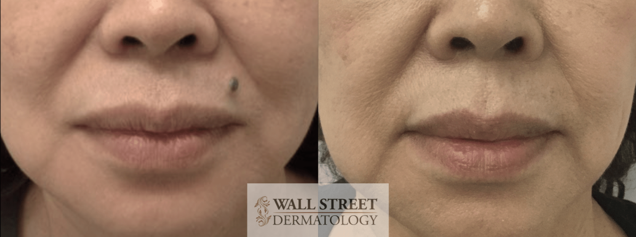 does insurance cover mole removal