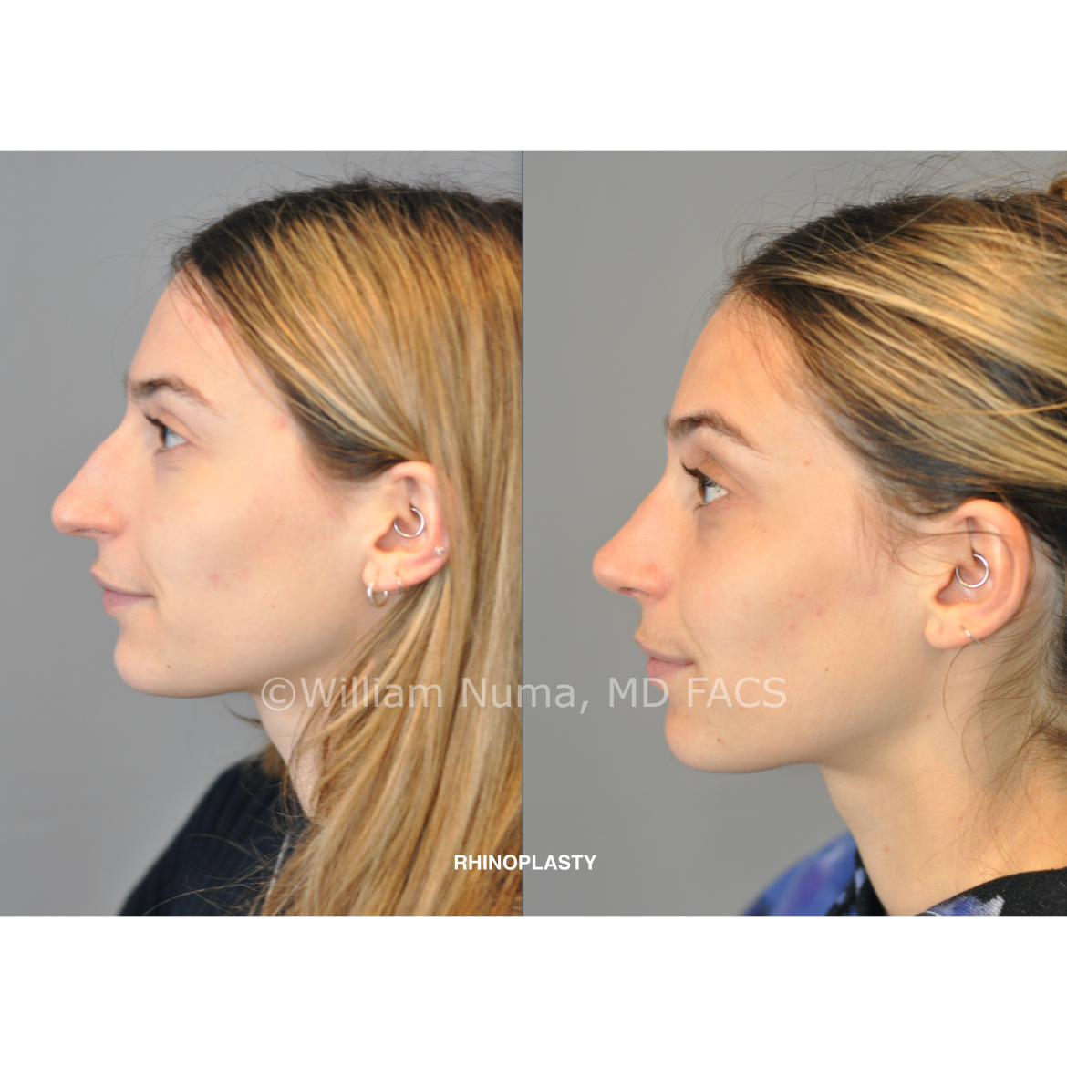 does insurance cover rhinoplasty terbaru