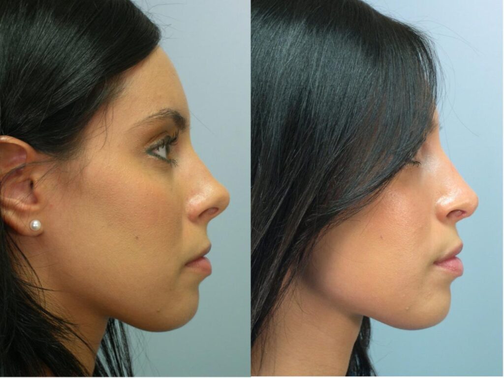 how much does a nose job cost with insurance terbaru