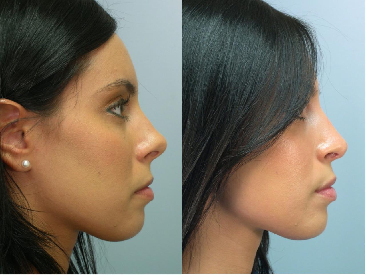 how much does a nose job cost with insurance terbaru