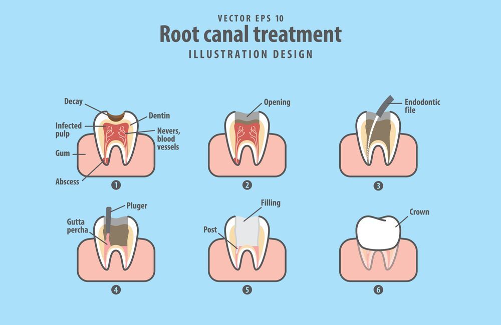 how much is a root canal and crown with insurance terbaru