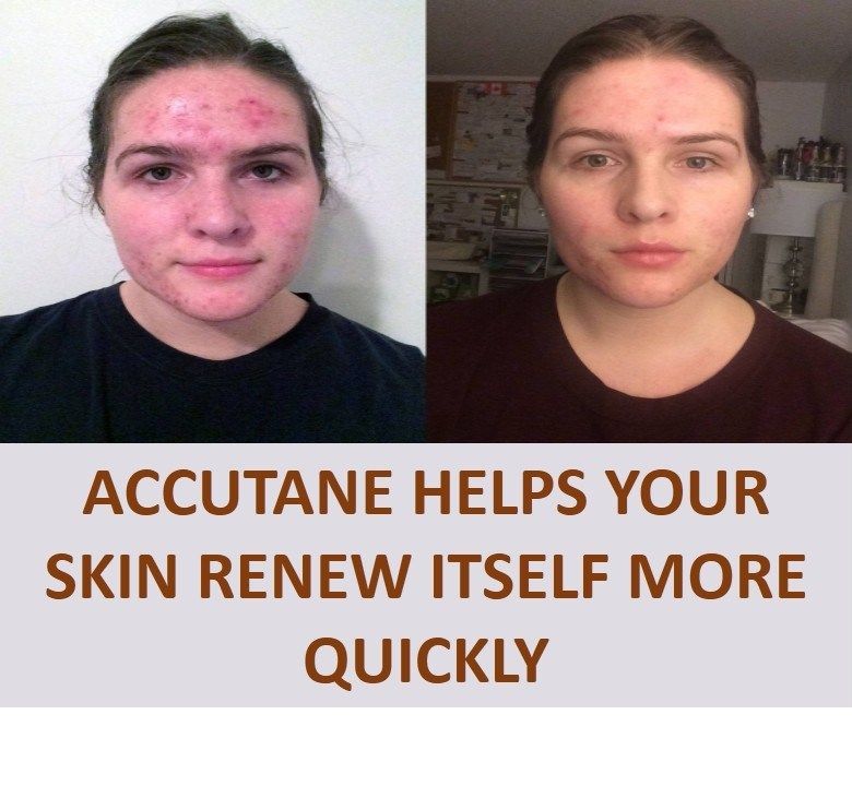 accutane isotretinoin 40mg capsule 10mg package goodrx
