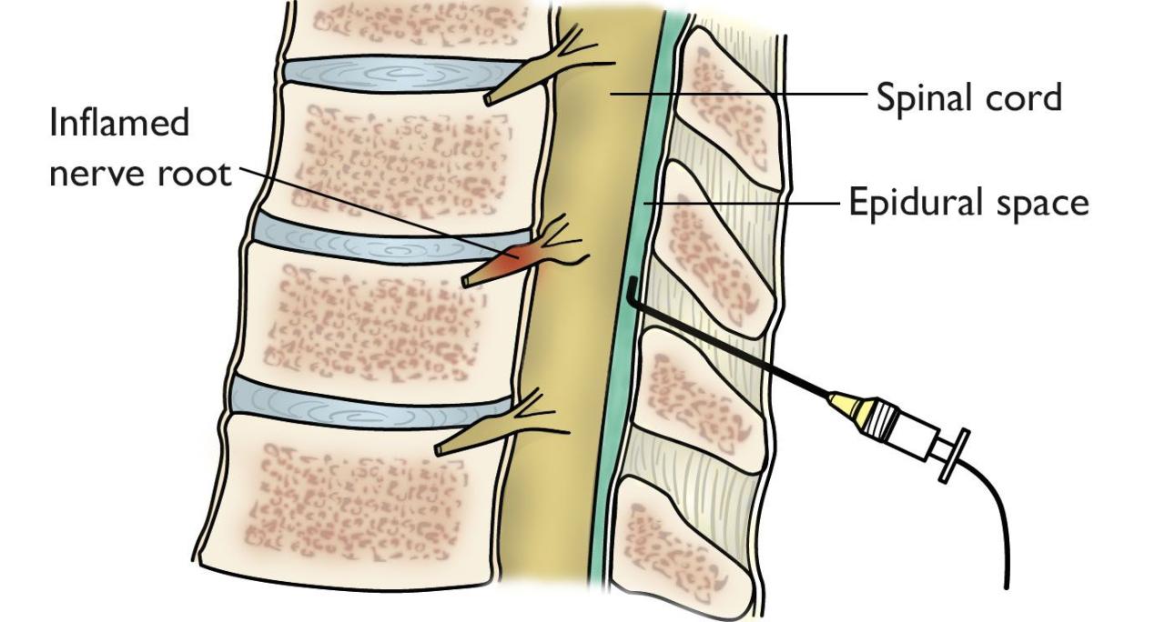 epidural injection spinal spine lumbar injections steroid back pain space types labor between pregnancy orthoinfo archives surgery relationship tag