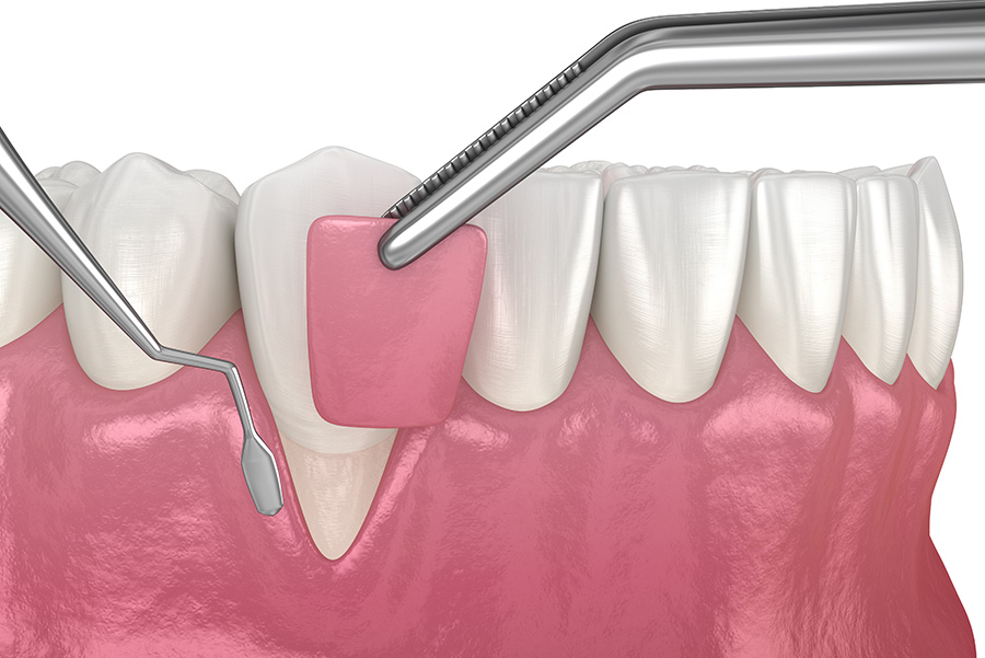 gum graft grafting teeth recession gums allograft grafts receding periodontal implant laser perio performed oakville