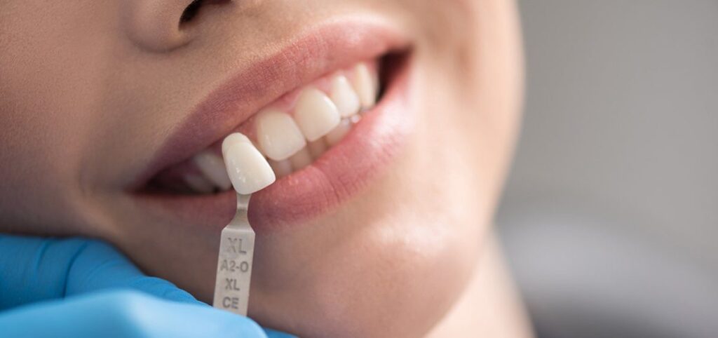 dental filling cost without insurance terbaru