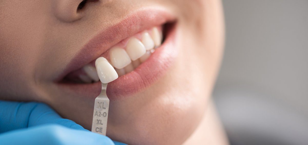 dental filling cost without insurance terbaru
