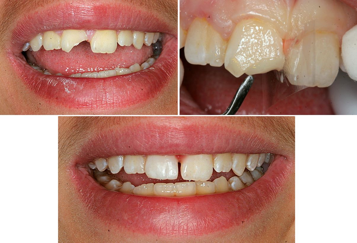 tooth chipped dentist march epping