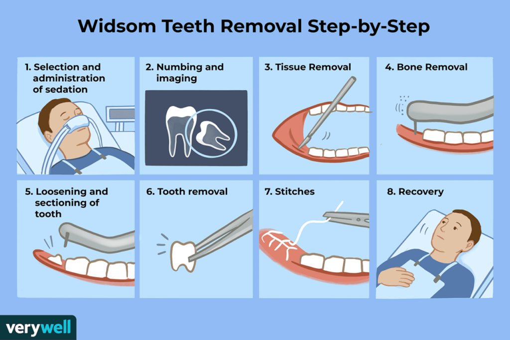 wisdom teeth removal tooth extraction vary
