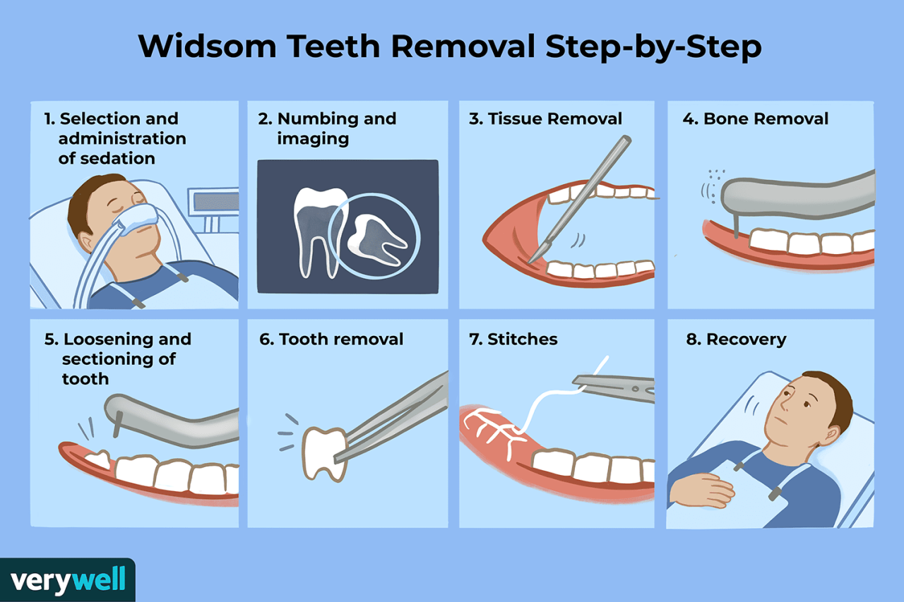 teeth removal allison hilary verywell verywellhealth