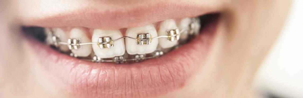 does insurance pay for braces terbaru