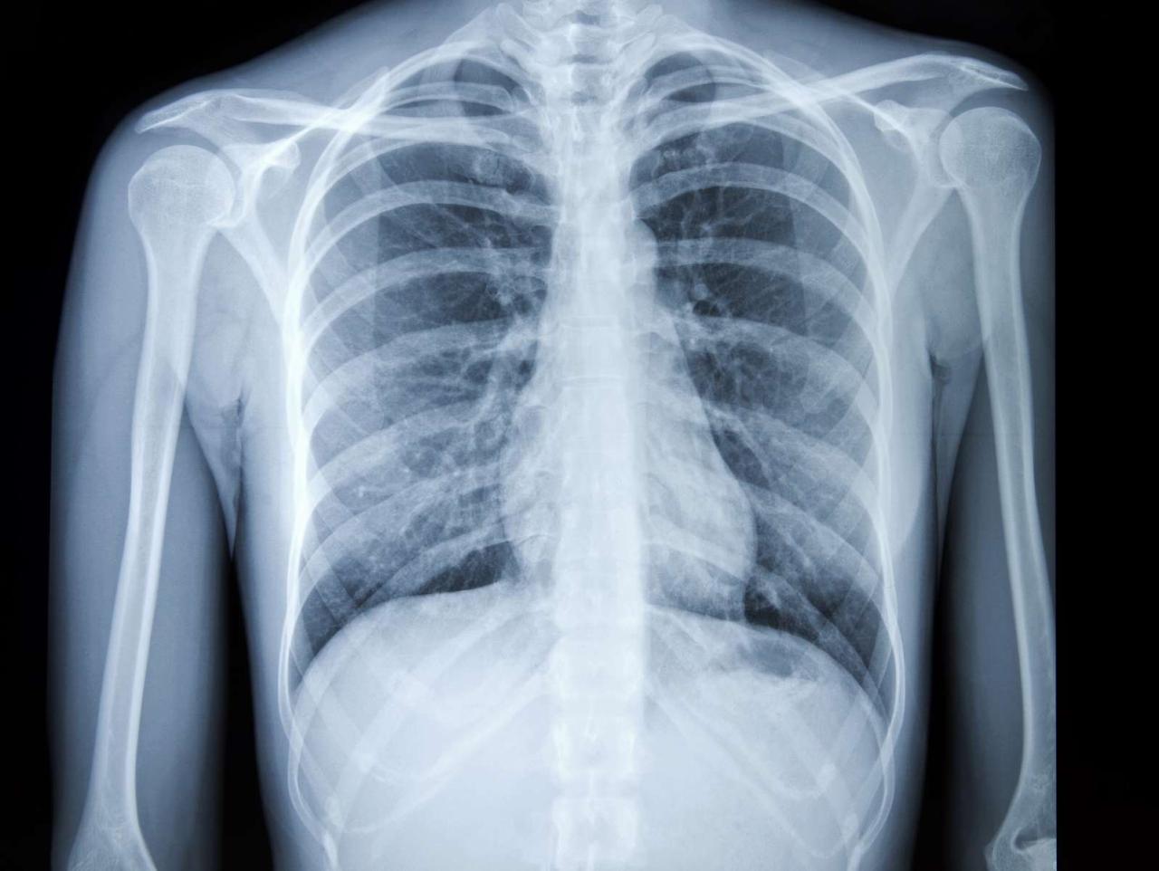 how much is a chest x ray without insurance terbaru