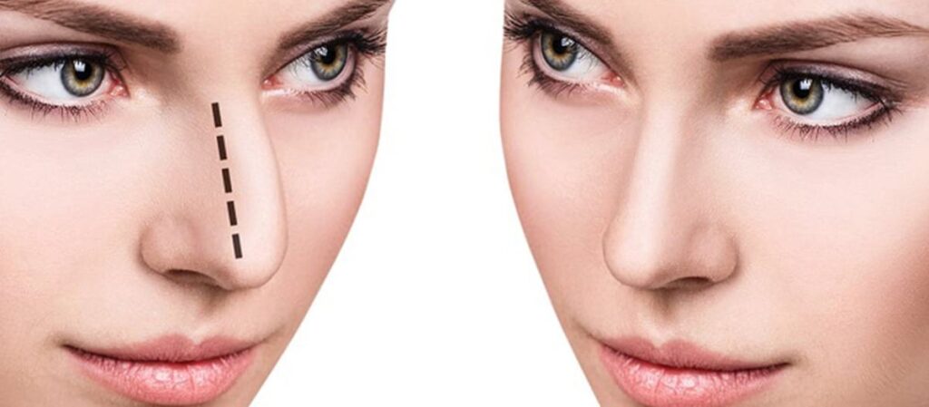 will insurance cover rhinoplasty