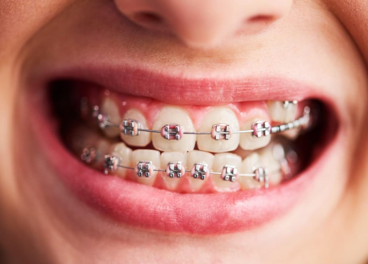 does insurance cover orthodontics terbaru