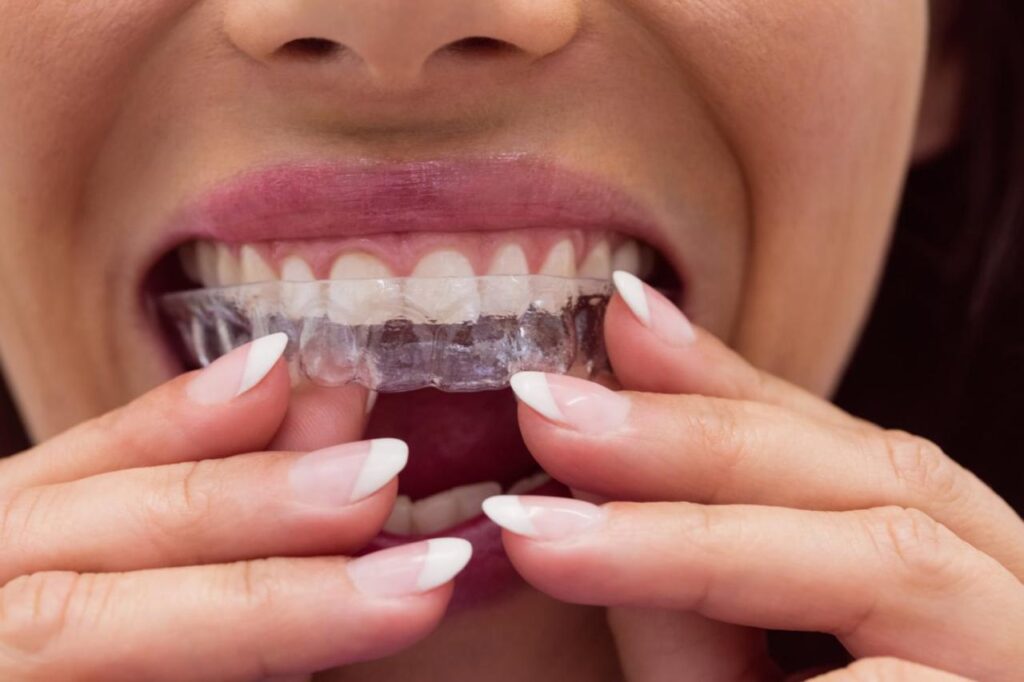 does invisalign covered by insurance