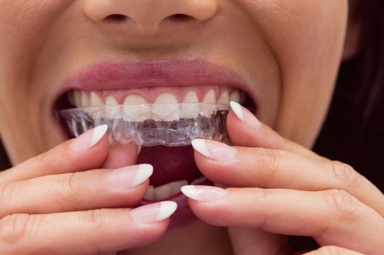 does invisalign covered by insurance