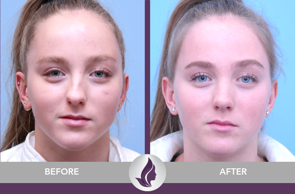 septum deviated insurance septoplasty nasal nose sinus surgeon fractured