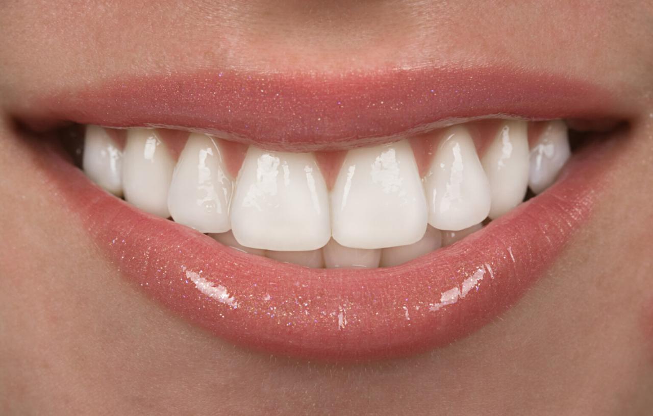 best dental insurance that covers veneers terbaru