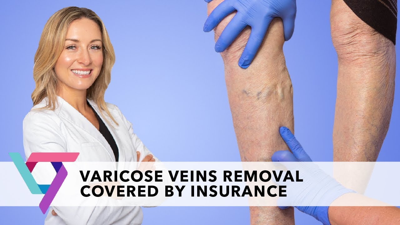 how to get insurance to pay for varicose vein removal terbaru