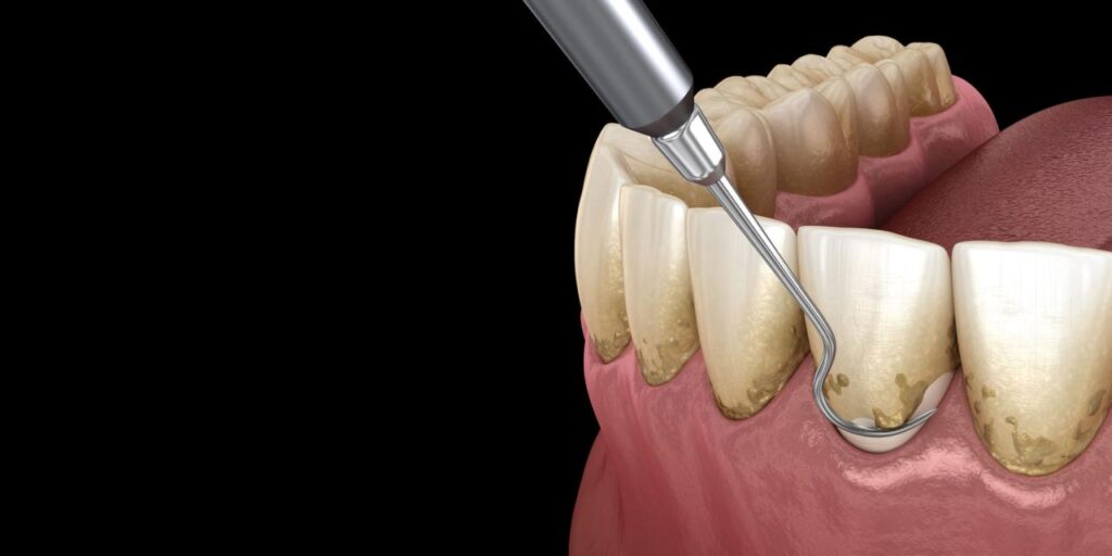 root scaling planing dental procedure periodontal necessary diagram association courtesy illustration american