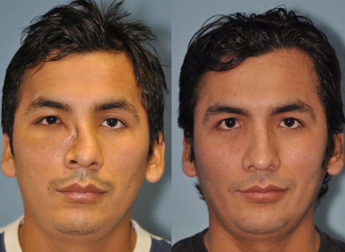 septoplasty rhinoplasty