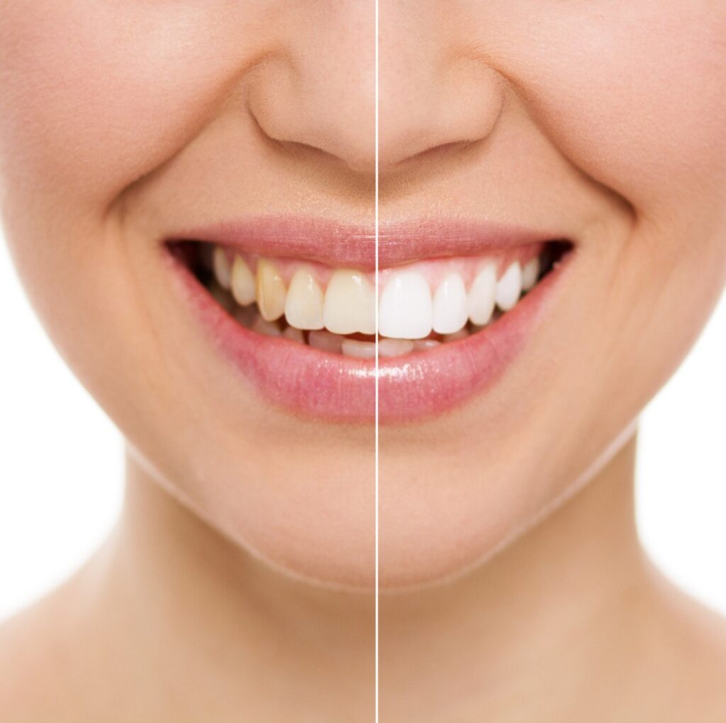 how much is teeth whitening without insurance