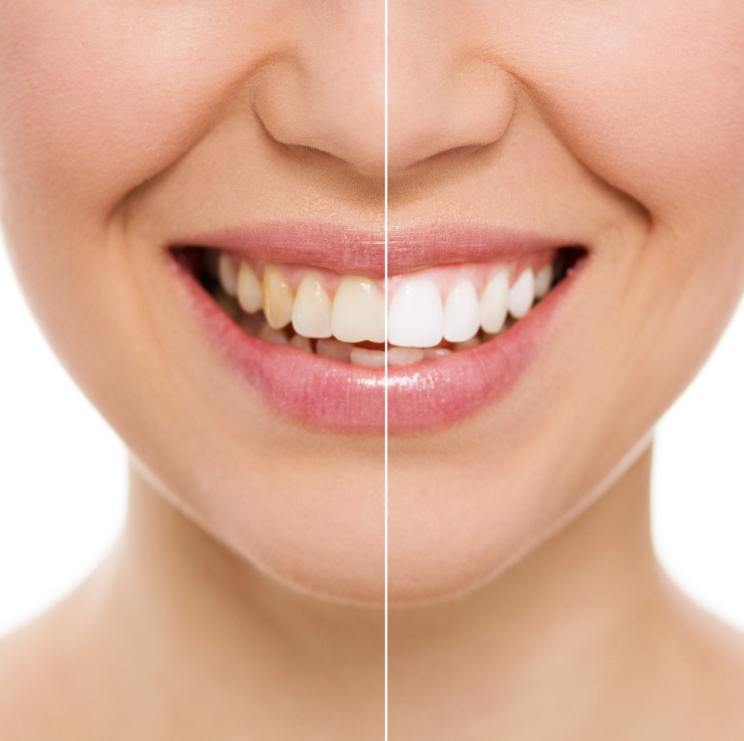 how much is teeth whitening without insurance