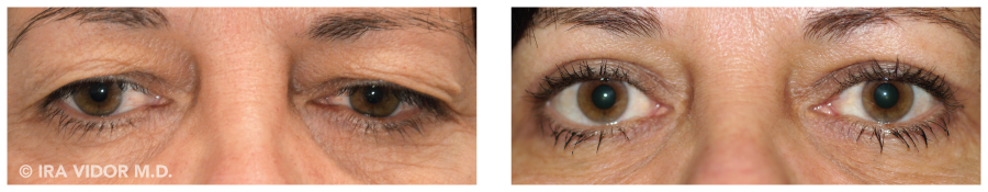 does insurance cover eyelid surgery terbaru